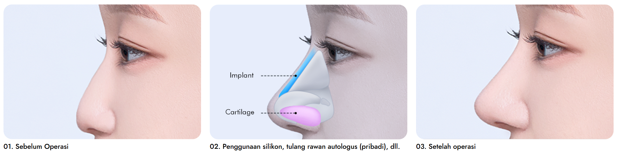 Operasi Hidung Hidung Datar Korea