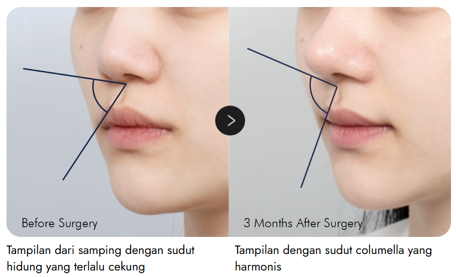 Operasi Hidung Singkat Sebelum dan Sesudah