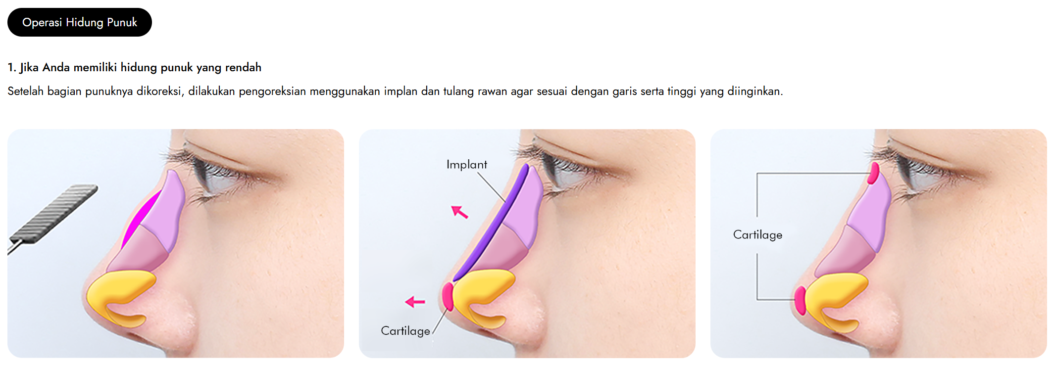 Operasi Hidung Punuk di Korea