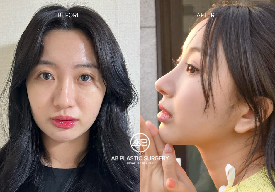 Operasi Hidung ala Korea untuk Batang Hidung yang Tinggi dan Elegan