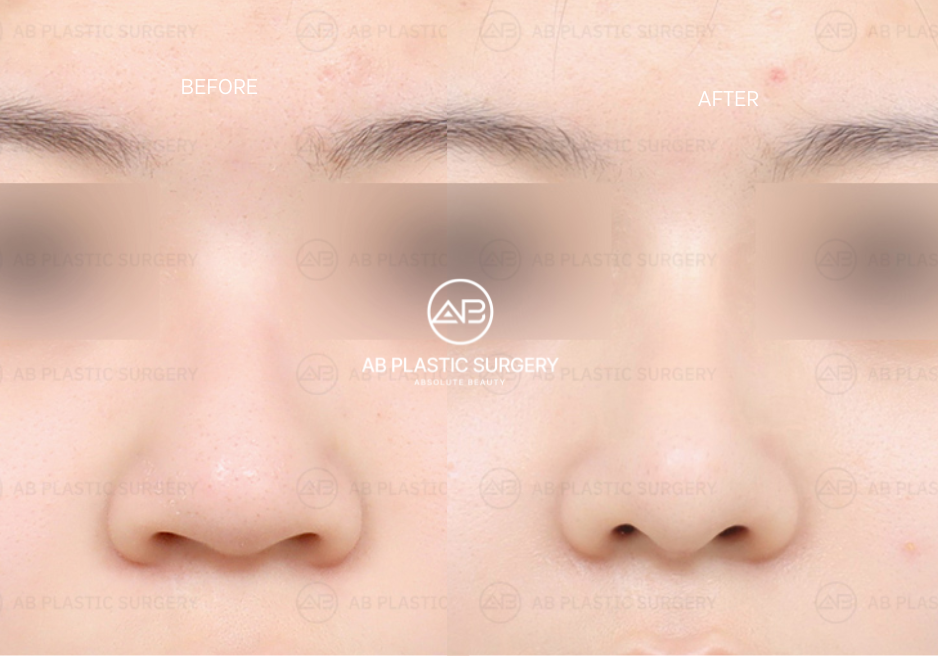 Operasi Pengecilan Lubang Hidung di AB Plastic Surgery Korea