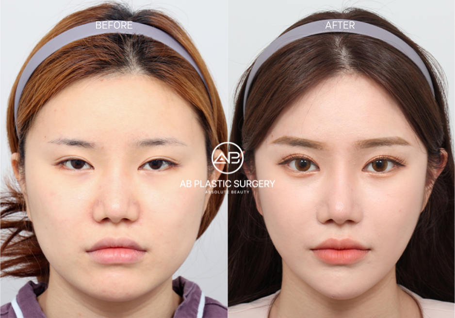 Canthoplasty untuk Operasi Mata Rubah di Korea