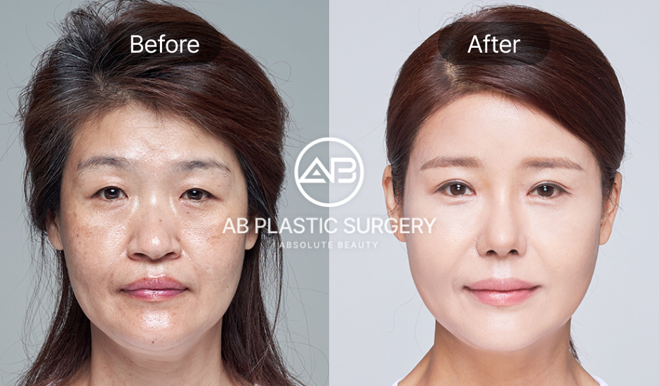 Foto sebelum dan sesudah facelift Korea