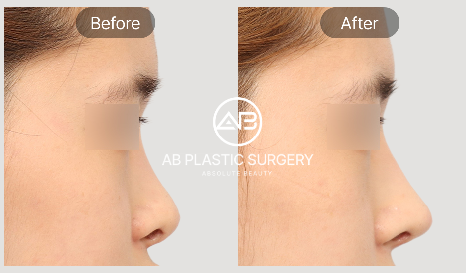 Gambar before after revisi hidung pendek atau terangkat di AB Plastic Surgery Korea
