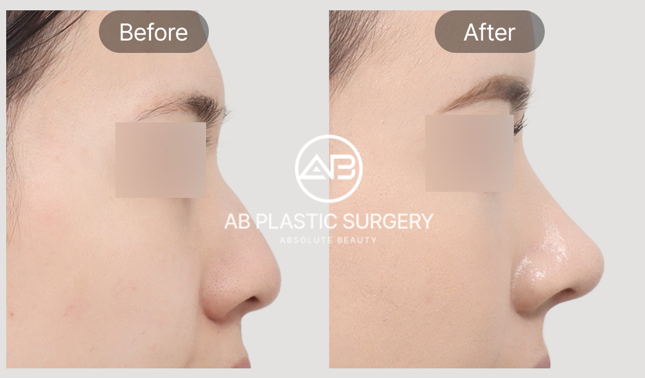 Gambar before after hasil revisi hidung dengan garis hidung ramping dan proporsional di AB Plastic Surgery Korea