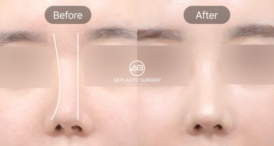 Perbandingan bentuk hidung bengkok sebelum dan sesudah operasi koreksi hidung miring