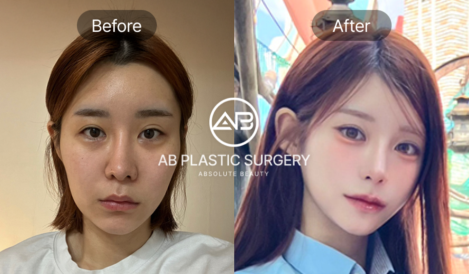 Sebelum dan sesudah operasi hidung miring – hasil alami dari Operasi Plastik AB Korea