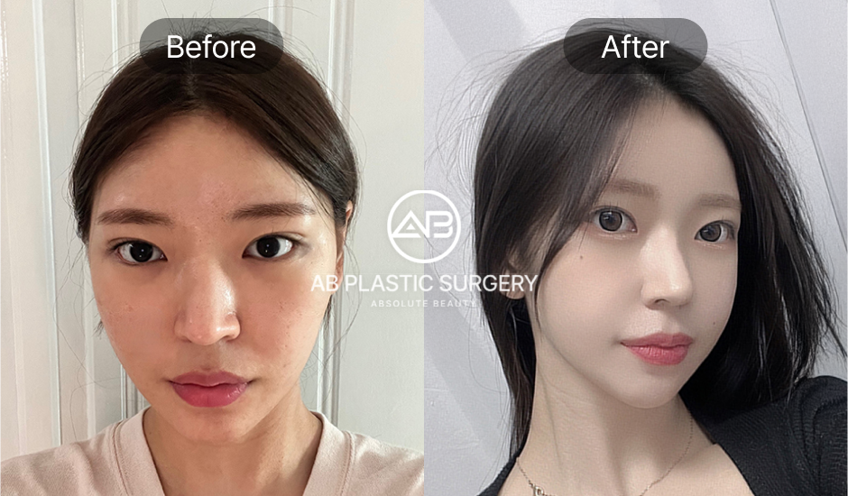 Analisis proporsi wajah setelah koreksi hidung miring di Korea