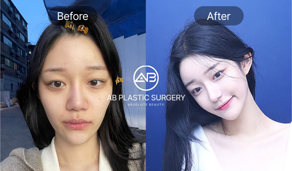 Foto pasien sebelum dan sesudah operasi koreksi hidung miring – hasil feminim dan simetris