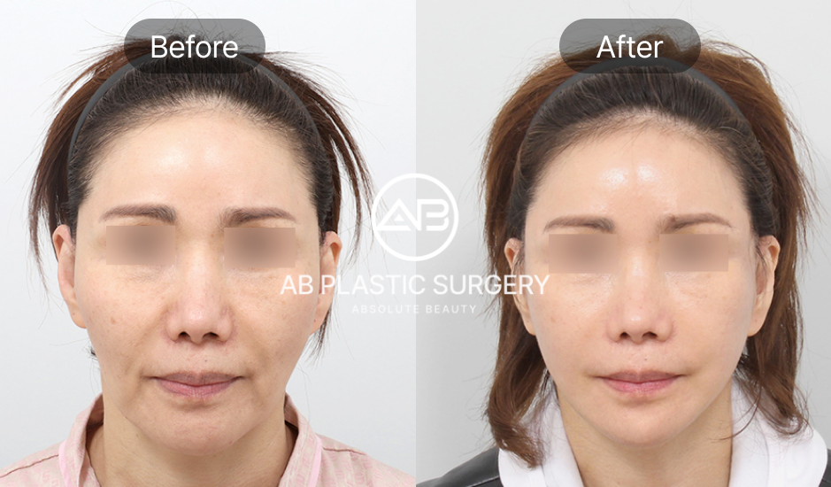 Foto before after skin tightening di Operasi Plastik AB Korea
