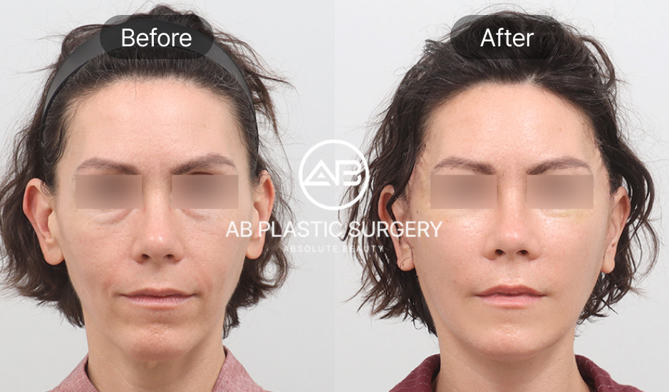 Foto before after skin tightening metode bedah di Operasi Plastik AB Korea