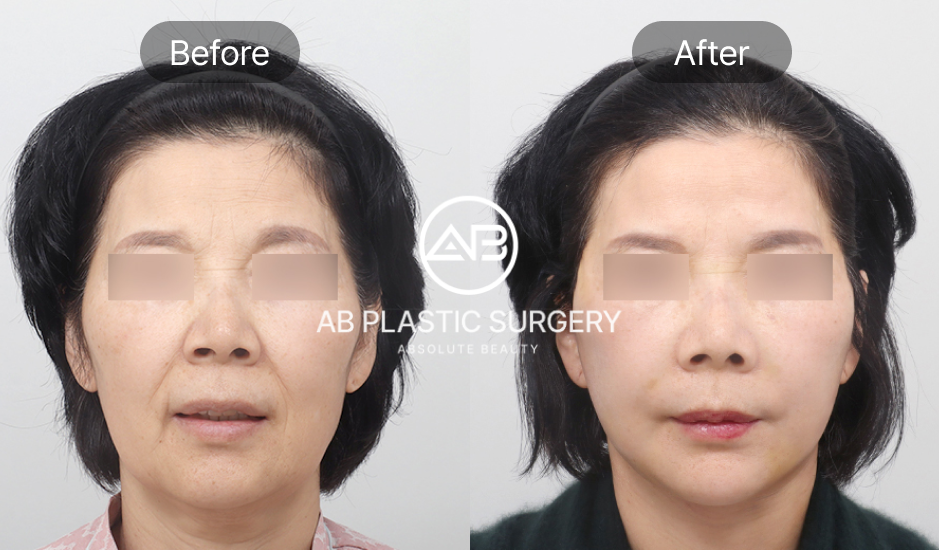 Foto before after skin tightening non-bedah di Operasi Plastik AB Korea