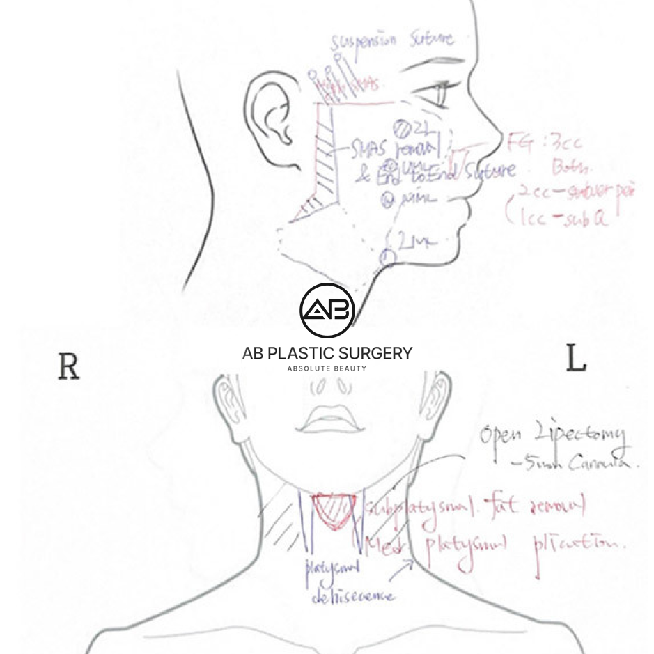 Ilustrasi prosedur bedah skin tightening di Operasi Plastik AB Korea