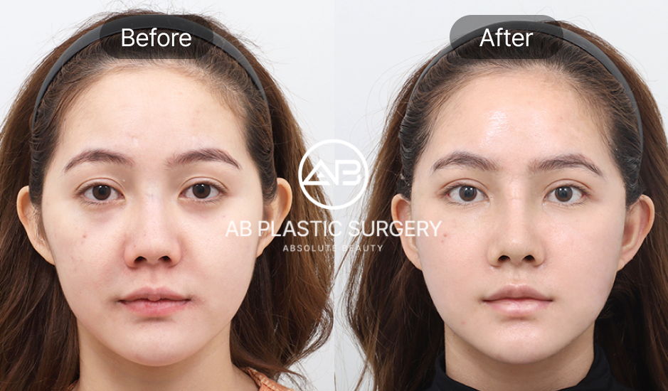 Foto before after skin tightening di Operasi Plastik AB Korea – hasil nyata perawatan wajah