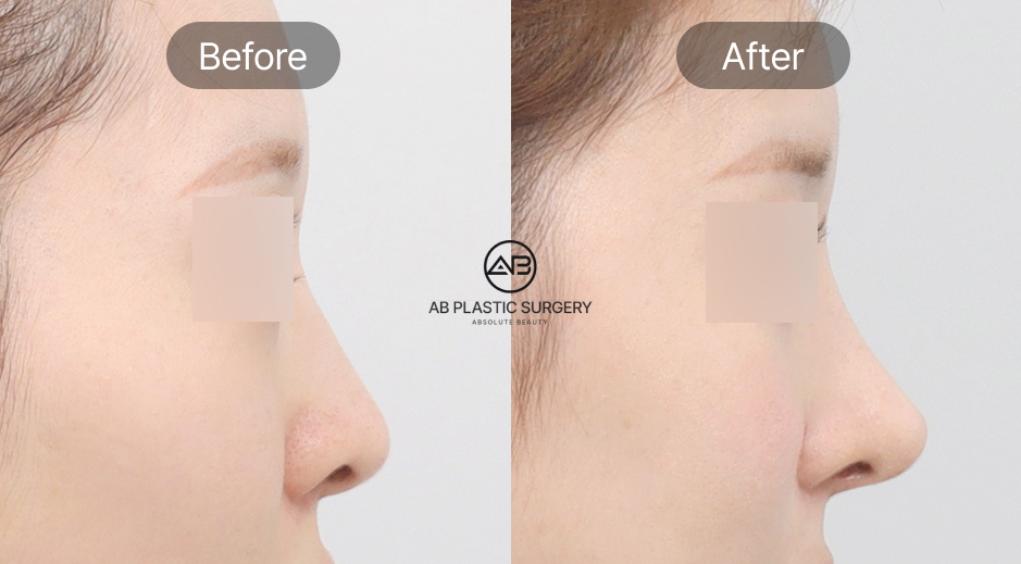 Foto sebelum dan sesudah operasi plastik hidung mancung di Operasi Plastik AB Korea, perbandingan bentuk hidung setelah koreksi