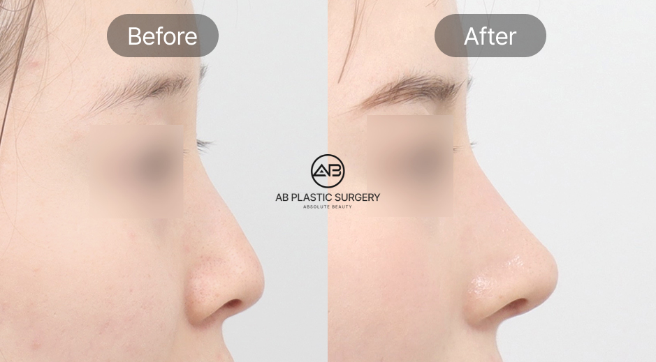 Foto sebelum dan sesudah operasi plastik hidung pesek di Operasi Plastik AB Korea, hasil perbaikan batang hidung agar lebih tinggi dan proporsional