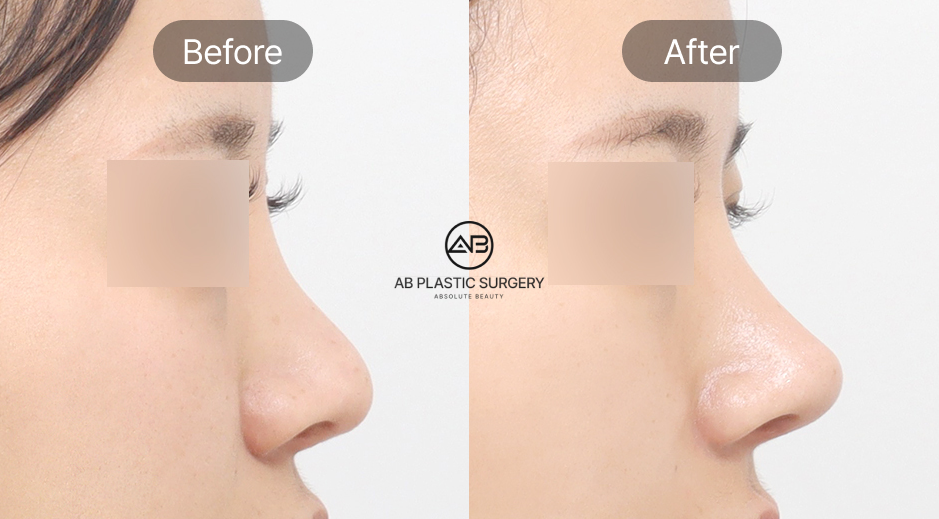 Foto sebelum dan sesudah operasi plastik hidung pesek di Operasi Plastik AB Korea, koreksi batang hidung untuk tampilan lebih tinggi dan proporsional