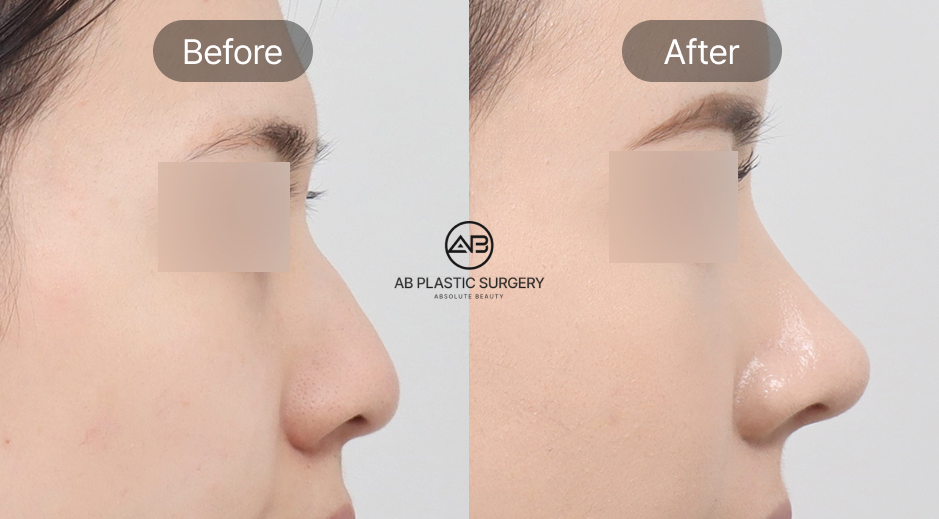 Foto sebelum dan sesudah operasi hidung di Operasi Plastik AB Korea, ilustrasi pentingnya mempertimbangkan kondisi kesehatan dan struktur wajah sebelum tindakan