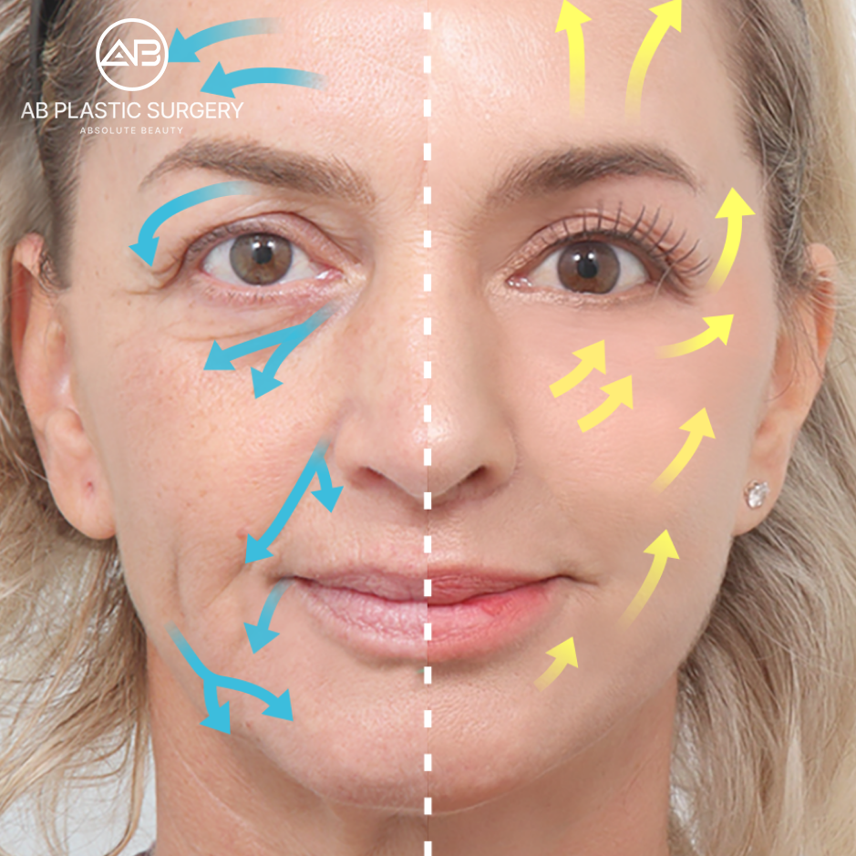 Ilustrasi perbandingan tanam benang vs facelift bedah di Operasi Plastik AB Korea, arah tarikan kulit wajah sebelum dan sesudah prosedur