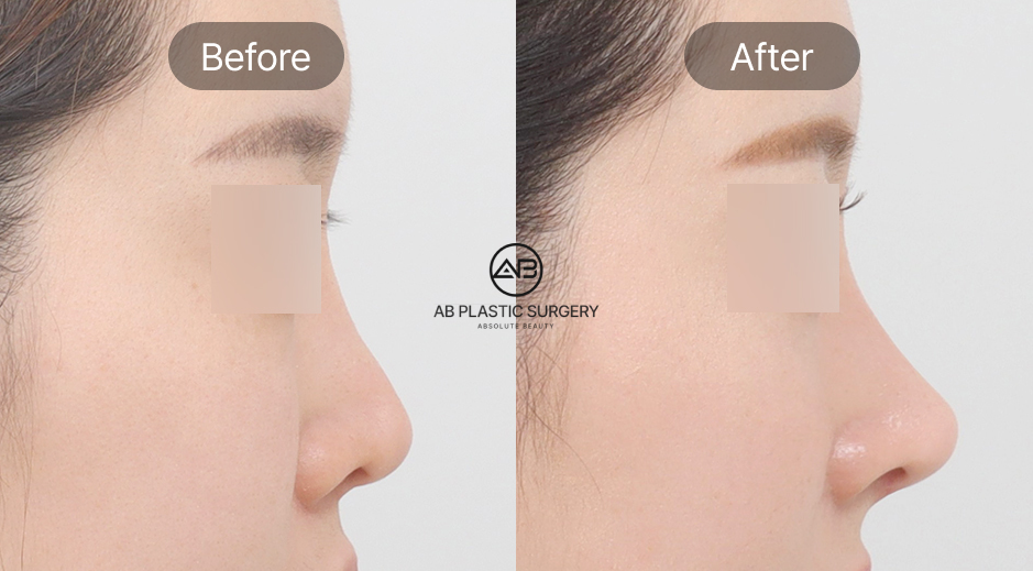 Foto sebelum dan sesudah operasi hidung di Operasi Plastik AB Korea, ilustrasi harapan dan realita hasil operasi serta pentingnya pemulihan yang tepat