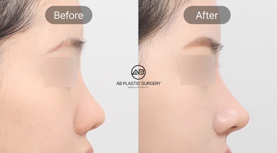 Foto sebelum dan sesudah operasi hidung di Operasi Plastik AB Korea, review pasien internasional menekankan hasil alami dan tingkat kepuasan tinggi