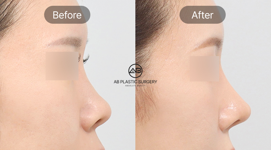 Foto sebelum dan sesudah operasi hidung di Operasi Plastik AB Korea, cerita nyata pasien dan testimoni menekankan profesionalisme dokter serta teknologi canggih