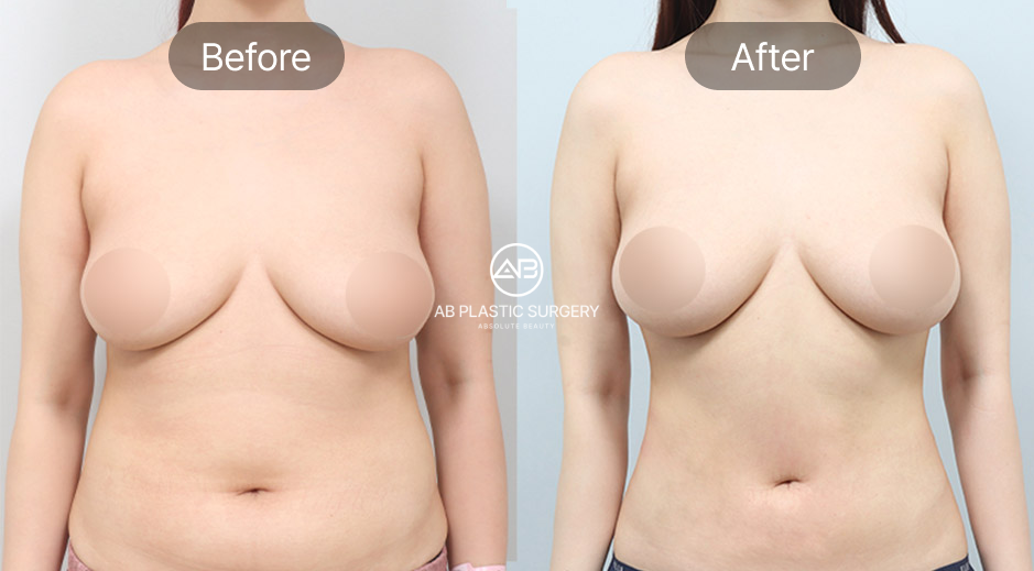 Foto sebelum dan sesudah prosedur sedot lemak perut di Operasi Plastik AB Korea