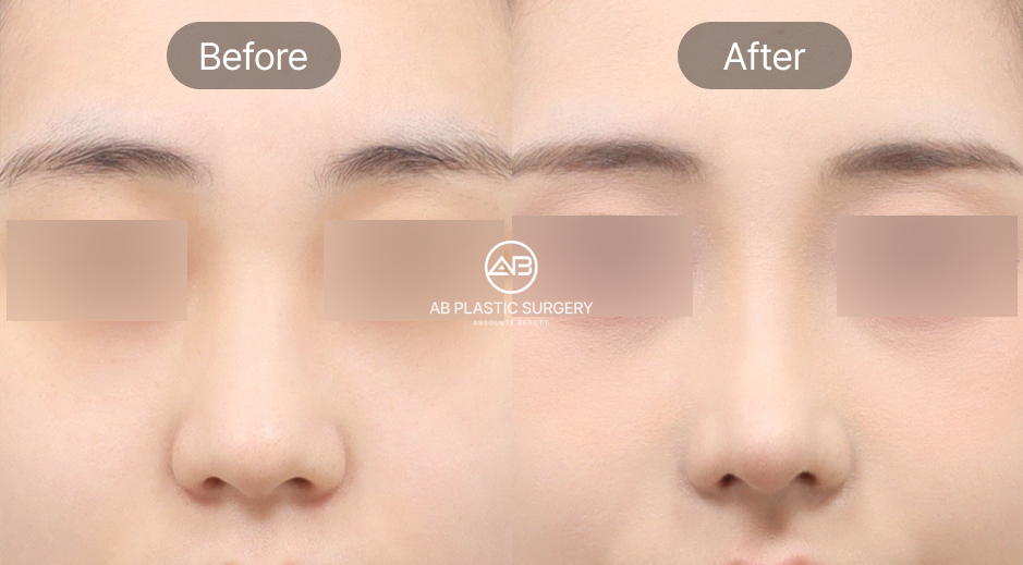 before after operasi hidung korea, hasil operasi hidung alami, augmentasi hidung di Operasi Plastik AB Korea, implan silikon hidung, perbandingan sebelum dan sesudah operasi hidung korea