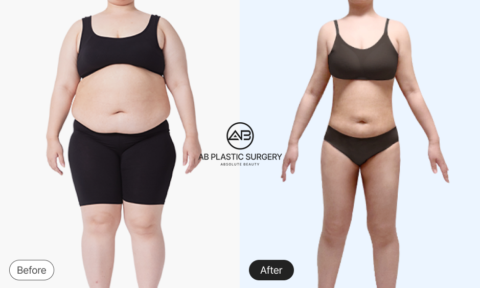 Foto sebelum dan sesudah sedot lemak perut pasien yang menjalani prosedur di Operasi Plastik AB Korea
