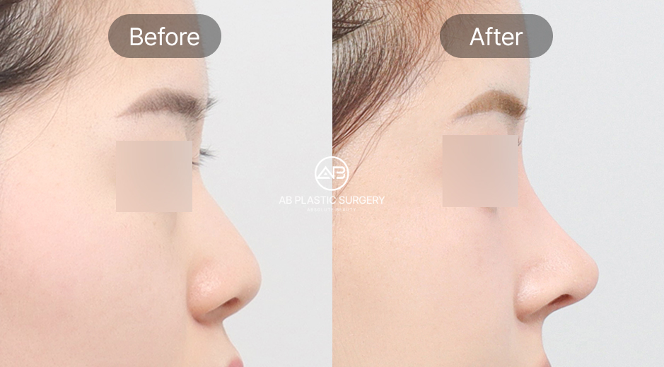 before after tip plasty korea, hasil operasi ujung hidung alami, operasi hidung korea bagian ujung hidung, perubahan sebelum dan sesudah operasi hidung di Operasi Plastik AB Korea, hidung mancung natural