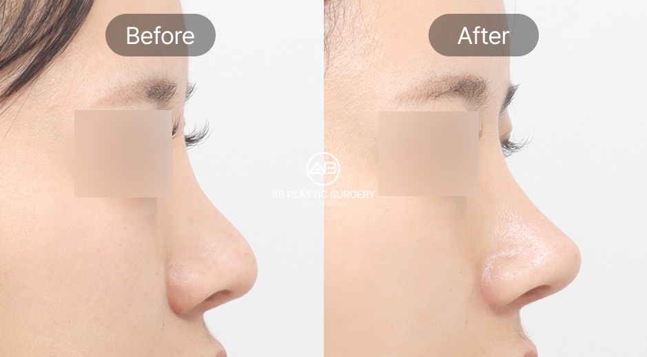 before after operasi revisi hidung korea, hasil perbaikan operasi hidung sebelumnya, operasi revisi hidung di Operasi Plastik AB Korea, tulang rawan rusuk untuk revisi hidung, perubahan sebelum dan sesudah operasi hidung korea