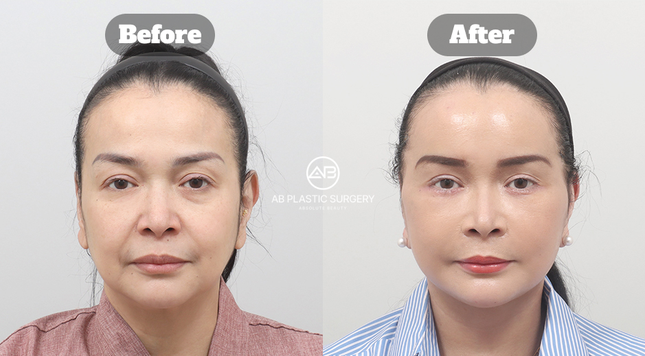 Hasil sebelum dan sesudah operasi facelift di AB Plastic Surgery Korea