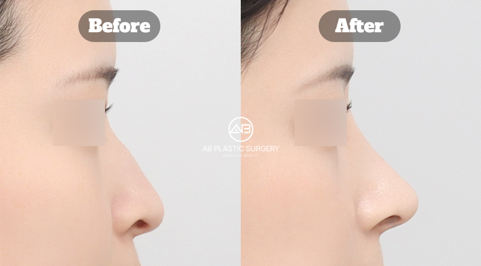 Hasil sebelum dan sesudah operasi hidung (rhinoplasty) di AB Plastic Surgery Korea