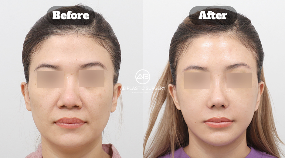 Perbandingan kondisi sebelum dan sesudah perawatan estetika regeneratif berbasis stem cell