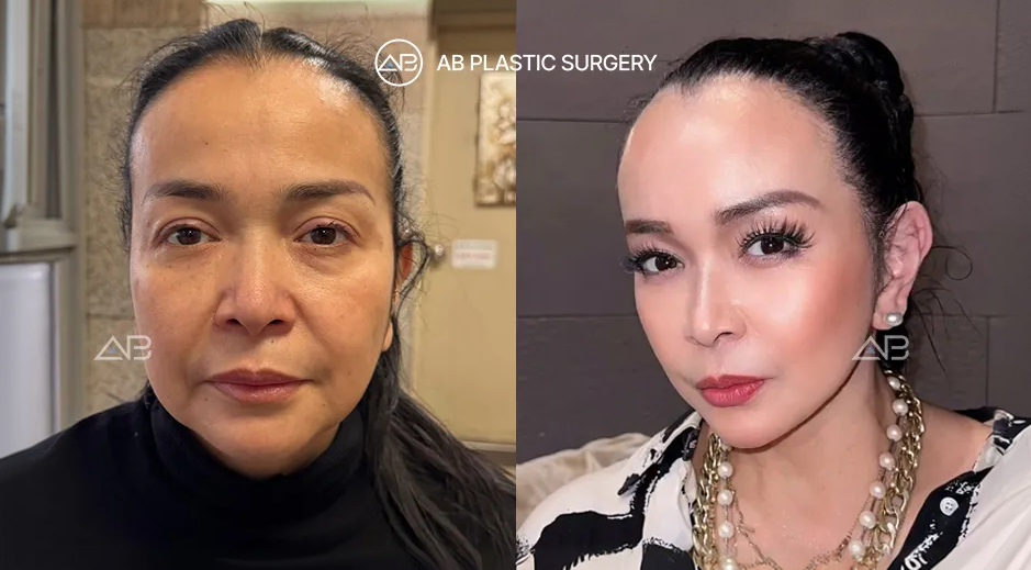 Hasil sebelum dan sesudah prosedur lifting wajah dan leher pada Jennifer Jill Armand Supit sebagai bagian dari tren anti-aging di Korea