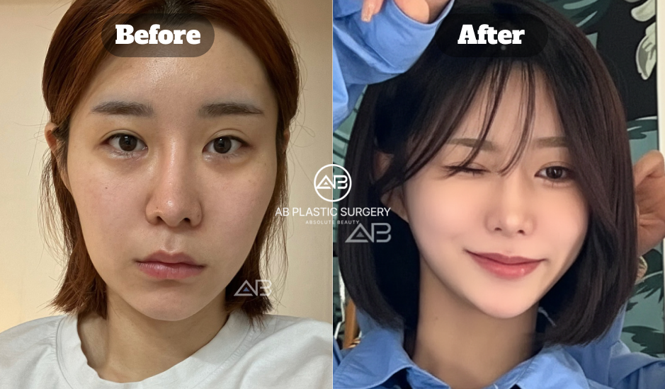 Contoh hasil revisi kelopak mata sebelum dan sesudah operasi di Korea