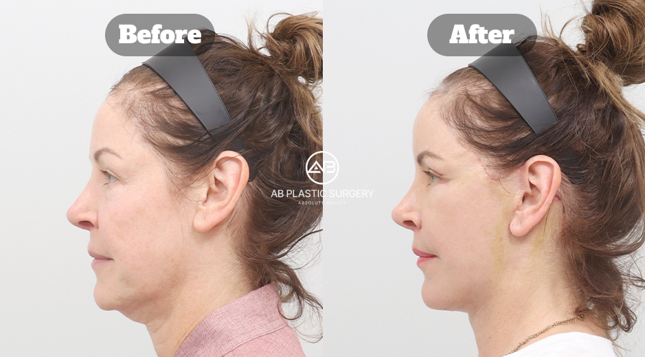 Before and after full face lifting, neck lifting, submentoplasty, reduksi philtrum, operasi kelopak mata atas dan bawah, serta transplantasi lemak wajah di Korea