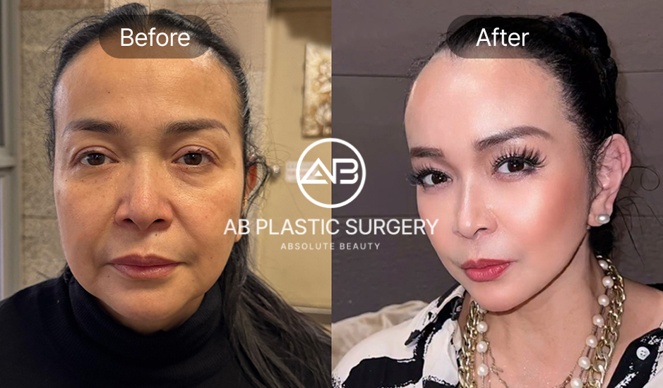 Before and after lifting leher dengan operasi neck lift di Korea oleh Operasi Plastik AB, hasil peremajaan leher alami pada Jennifer Jill Armand Supit