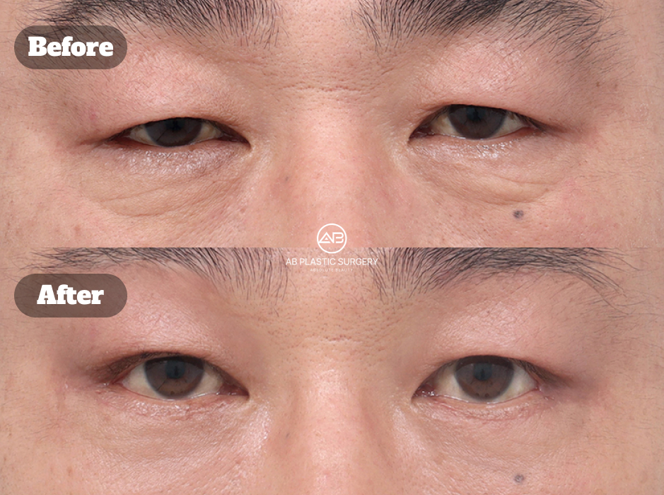Review foto sebelum dan sesudah operasi kelopak mata bawah, eyebrow lift, dan endoscopic forehead lift di Operasi Plastik AB Korea