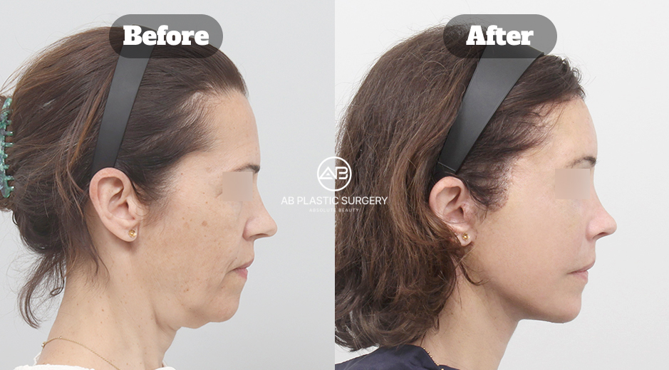 Before and after full SMAS lifting, endotine forehead lift, neck lift, dan pengencangan otot double chin di Korea oleh Operasi Plastik AB