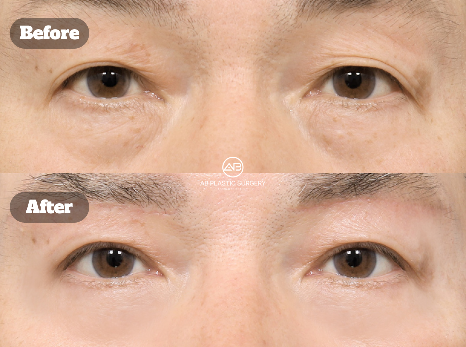 Foto sebelum dan sesudah operasi upper eyelid lifting, eyebrow lift, dan lower eyelid di Operasi Plastik AB Korea