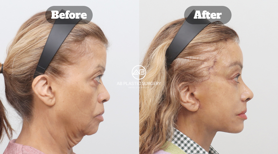 Before and after full face lifting, lifting dahi endotine, neck lifting, submentoplasty, transplantasi lemak wajah, dan operasi kelopak mata atas di Korea