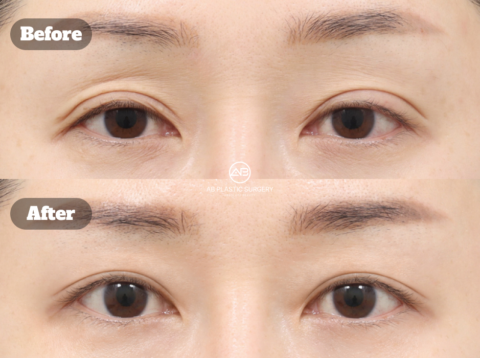 Hasil sebelum dan sesudah koreksi mata sayatan dan revisi mata di Seoul