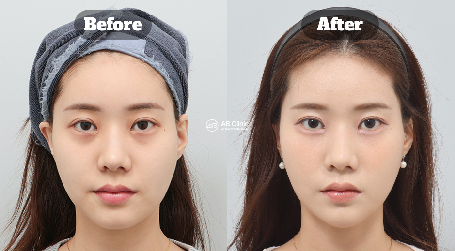 Perbandingan before after perawatan HIFU Korea untuk mengencangkan wajah dan memperbaiki kontur alami