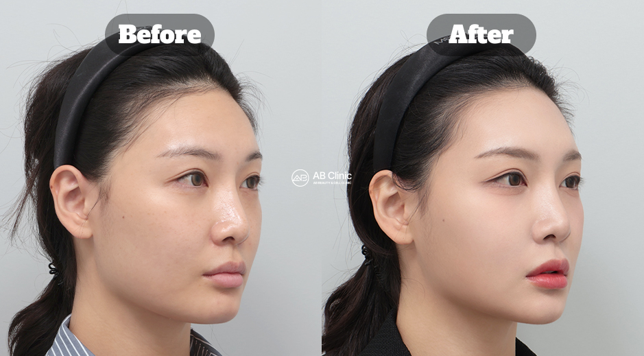 Perbandingan before after perawatan Ultherapy di Korea untuk meningkatkan elastisitas dan kontur wajah