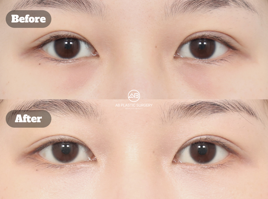 Before after results of under eye fat repositioning to improve tired looking eyes
