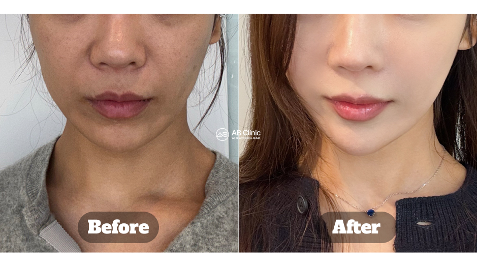 Ulasan dan perbandingan before after perawatan Ultherapy di Korea untuk pengencangan dan kontur wajah alami