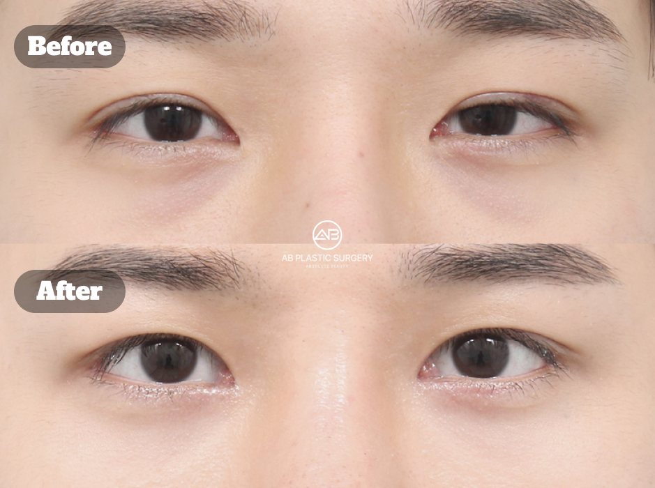 Before after results of male under eye fat repositioning to reduce tired looking eyes