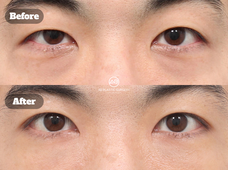 Before after male eye surgery including ptosis correction, front epicanthoplasty, and under eye fat repositioning