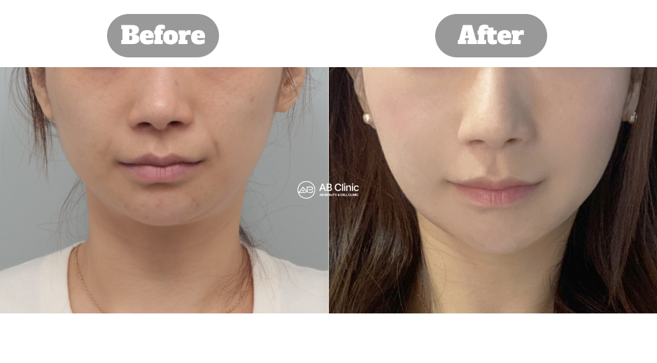 Perbandingan before after perawatan Ultherapy 200 shots di Korea untuk pengencangan dan kontur wajah